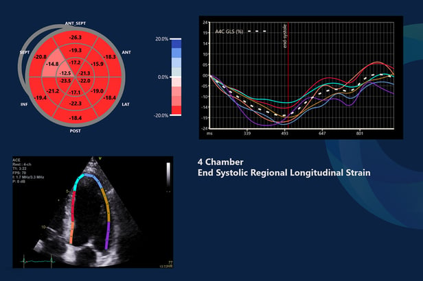 An image showing a Strain report on Ultromics' EchoGo Software