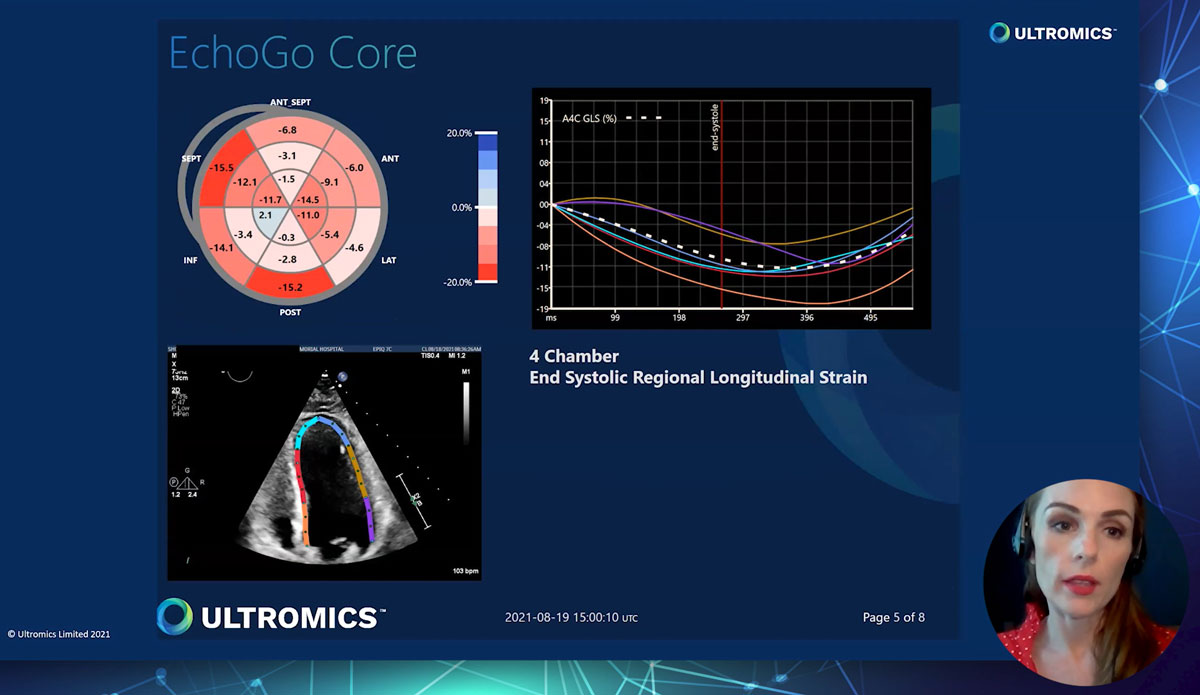 Takotsubo Cardiomyopathy Echo Case Study