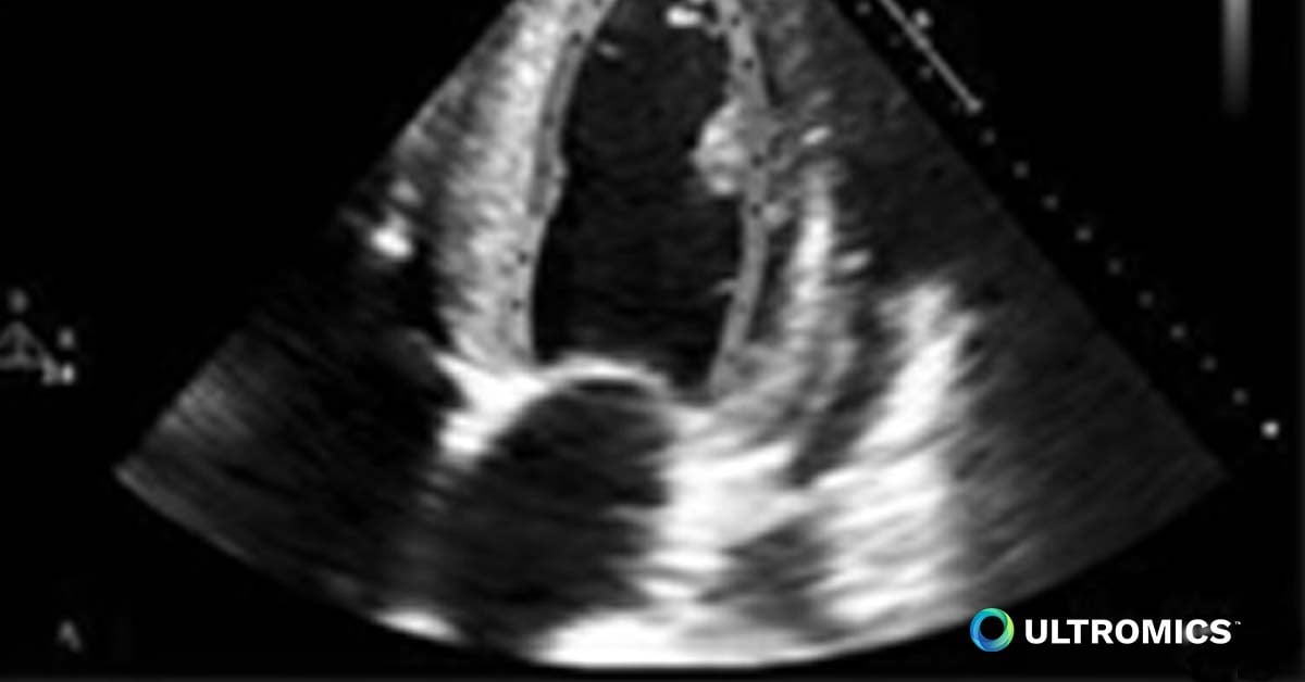 lv strain echo