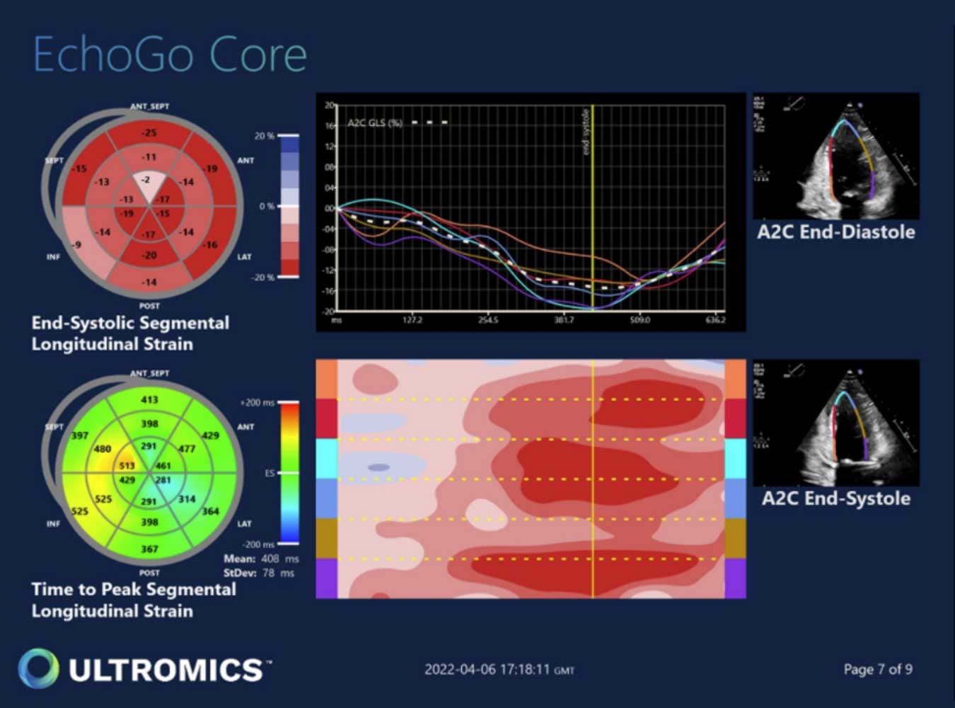 Global longitudinal strain can improve the characterization of Stage A and  B heart failure - Ultromics